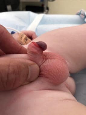 Severe penile chordee. Note extreme ventral curvat